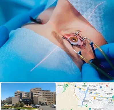 عمل prk چشم در صیاد شیرازی مشهد