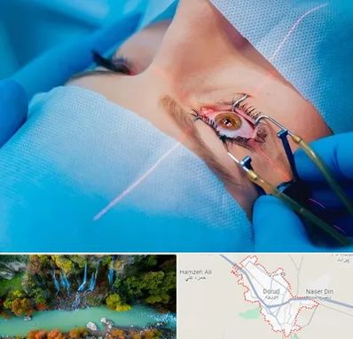 عمل prk چشم در دورود