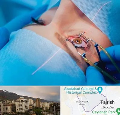 عمل prk چشم در زعفرانیه 