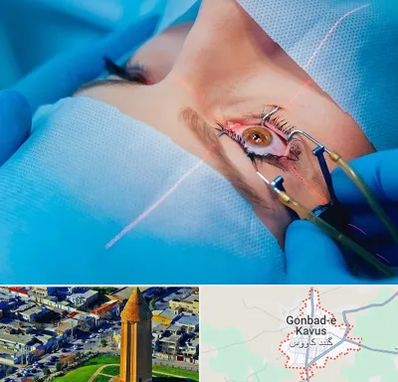 عمل prk چشم در گنبد کاووس