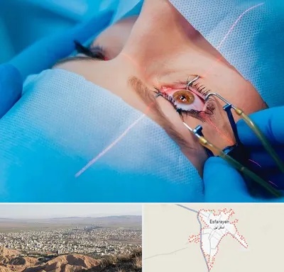 عمل prk چشم در اسفراین