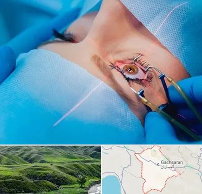 عمل prk چشم در گچساران