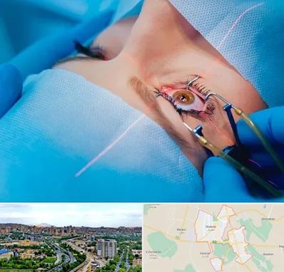 عمل prk چشم در شهریار