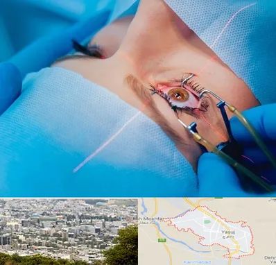 عمل prk چشم در یاسوج
