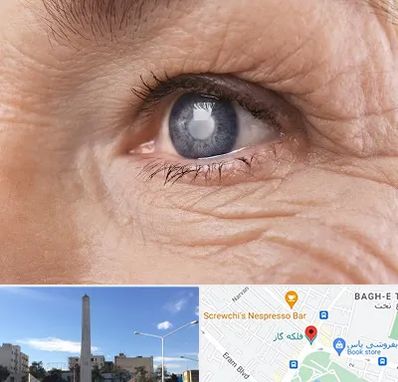 متخصص آب مروارید در فلکه گاز شیراز