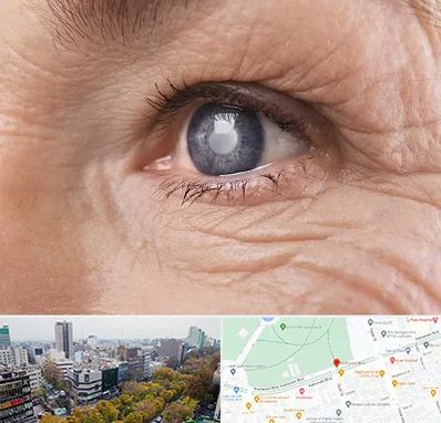 متخصص آب مروارید در بلوار کشاورز