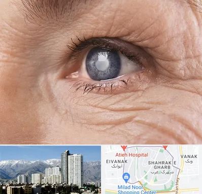 متخصص آب مروارید در شهرک غرب