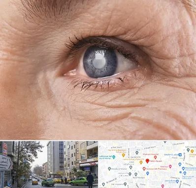 متخصص آب مروارید در فاطمی