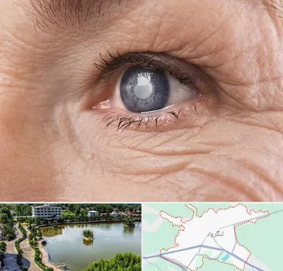 متخصص آب مروارید در لنگرود