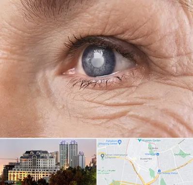 متخصص آب مروارید در فرشته