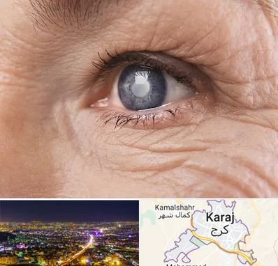 متخصص آب مروارید در کرج