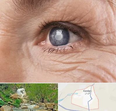 متخصص آب مروارید در کردان