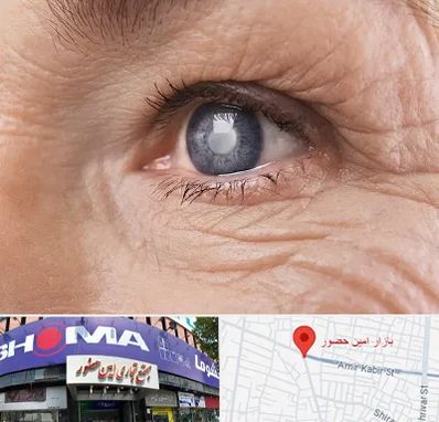 متخصص آب مروارید در امین حضور