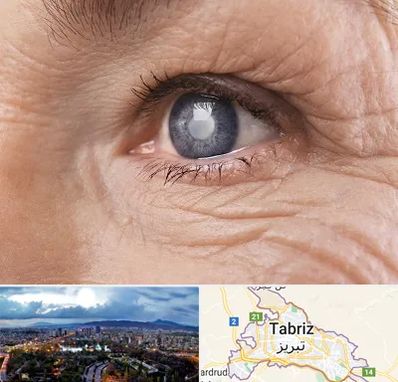 متخصص آب مروارید در تبریز