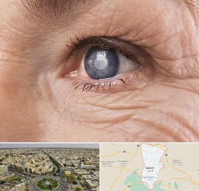 متخصص آب مروارید در قزوین