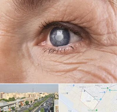 متخصص آب مروارید در کیانمهر کرج