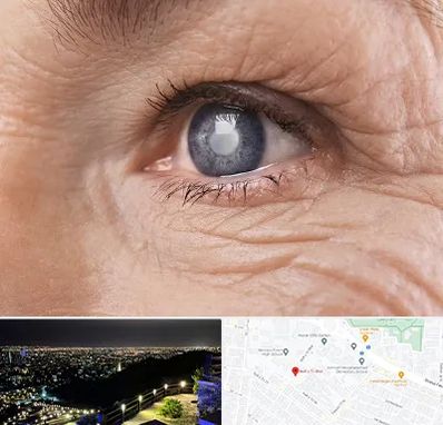 متخصص آب مروارید در هفت تیر مشهد