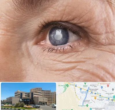 متخصص آب مروارید در صیاد شیرازی مشهد