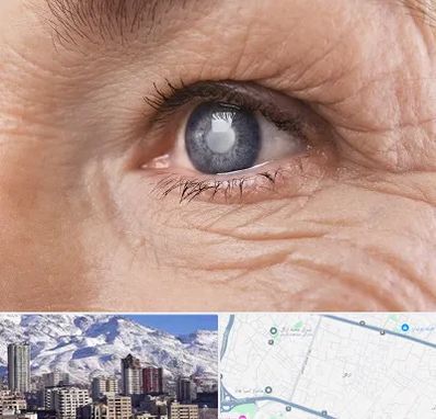 متخصص آب مروارید در ازگل