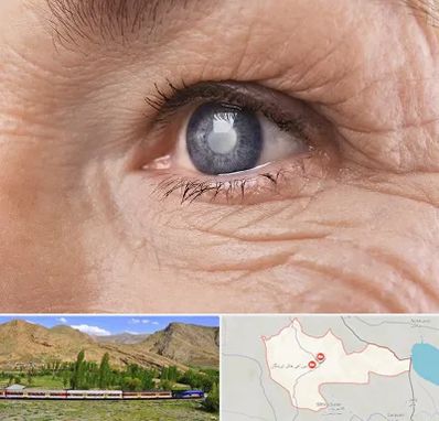 متخصص آب مروارید در خاش