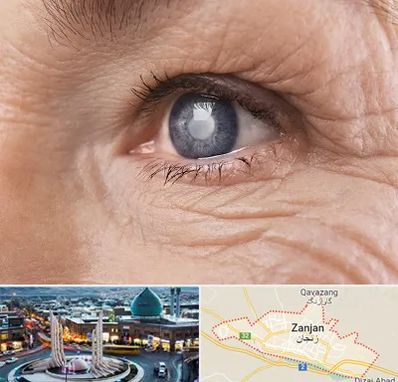 متخصص آب مروارید در زنجان