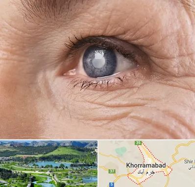 متخصص آب مروارید در خرم آباد