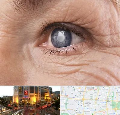 متخصص آب مروارید در جنت آباد تهران