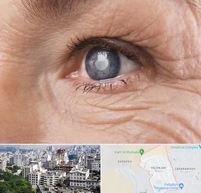 متخصص آب مروارید در ولنجک