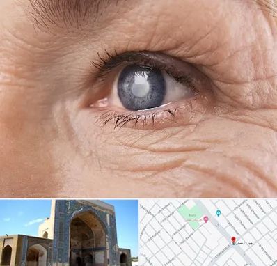 متخصص آب مروارید در مصلی مشهد