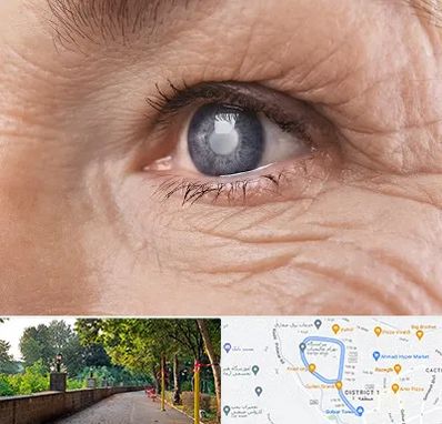 متخصص آب مروارید در فلکه گاز رشت