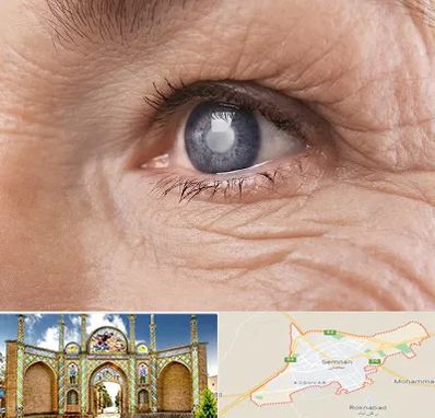 متخصص آب مروارید در سمنان
