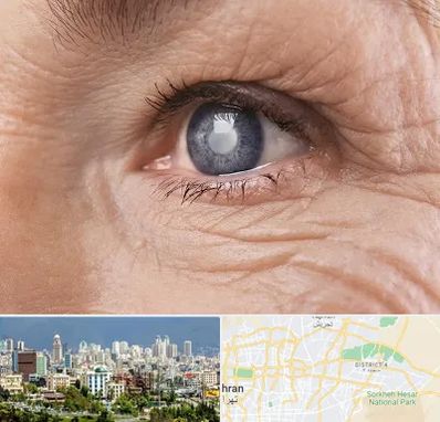 متخصص آب مروارید در شرق تهران