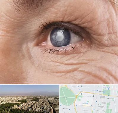 متخصص آب مروارید در نازی آباد