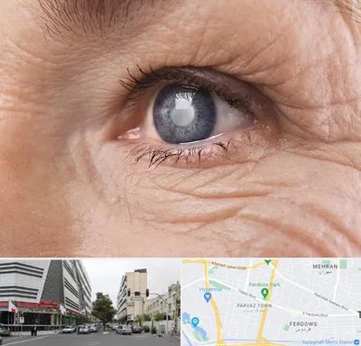 متخصص آب مروارید در بلوار فردوس