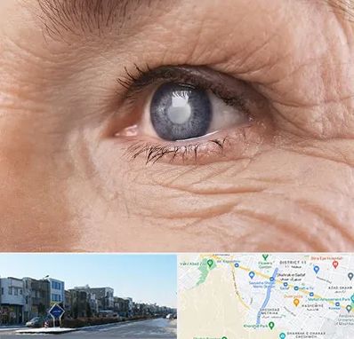 متخصص آب مروارید در شریعتی مشهد