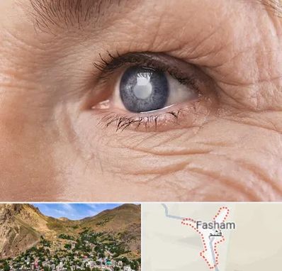 متخصص آب مروارید در فشم