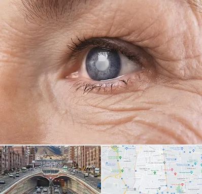 متخصص آب مروارید در منطقه 10 تهران