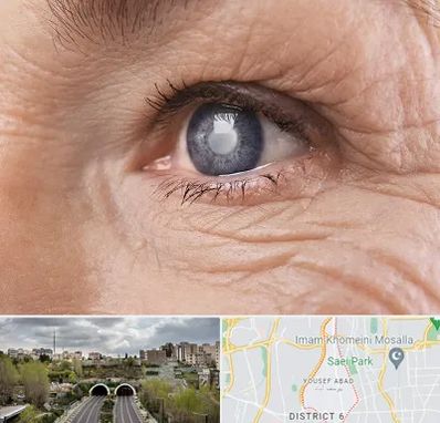 متخصص آب مروارید در یوسف آباد