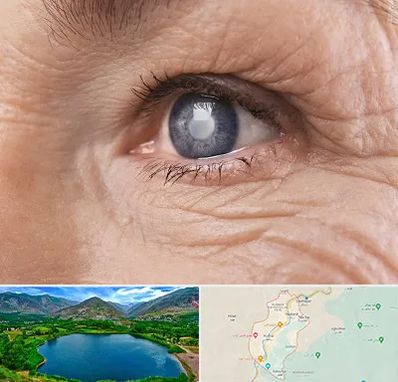 متخصص آب مروارید در رودبار