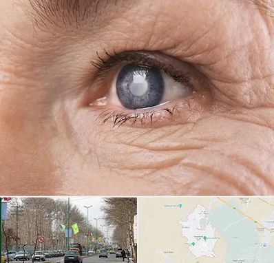 متخصص آب مروارید در نظرآباد کرج