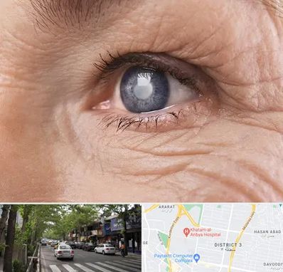 متخصص آب مروارید در ظفر