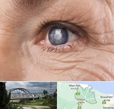 متخصص آب مروارید در چالوس