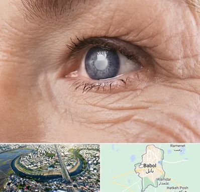 متخصص آب مروارید در بابل