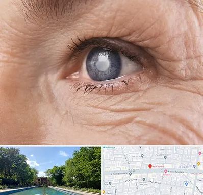 متخصص آب مروارید در هشت بهشت اصفهان