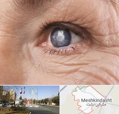 متخصص آب مروارید در مشکین دشت