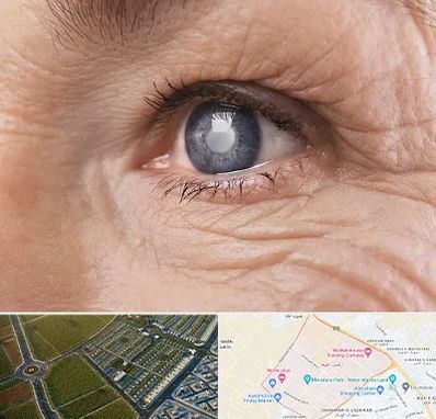 متخصص آب مروارید در الهیه مشهد