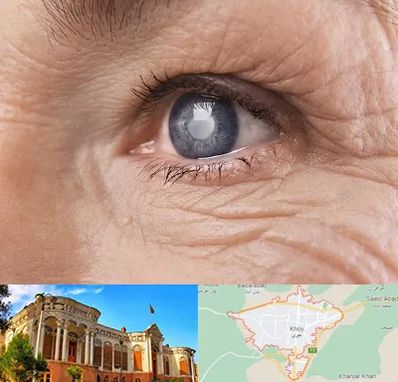 متخصص آب مروارید در خوی