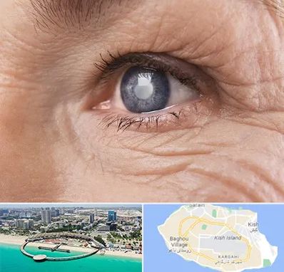 متخصص آب مروارید در کیش