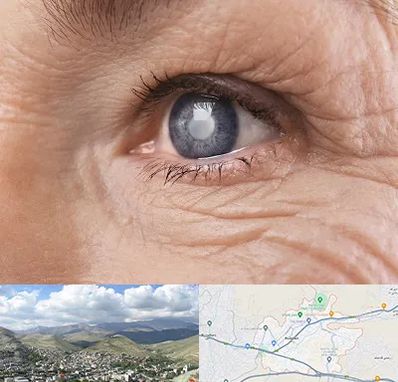 متخصص آب مروارید در رودهن