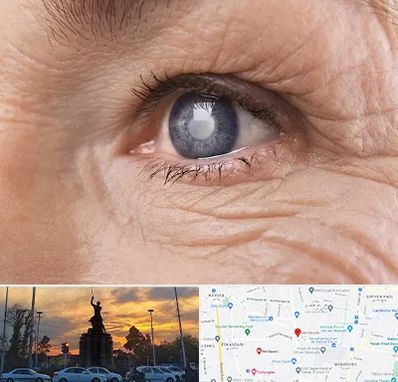 متخصص آب مروارید در میدان حر